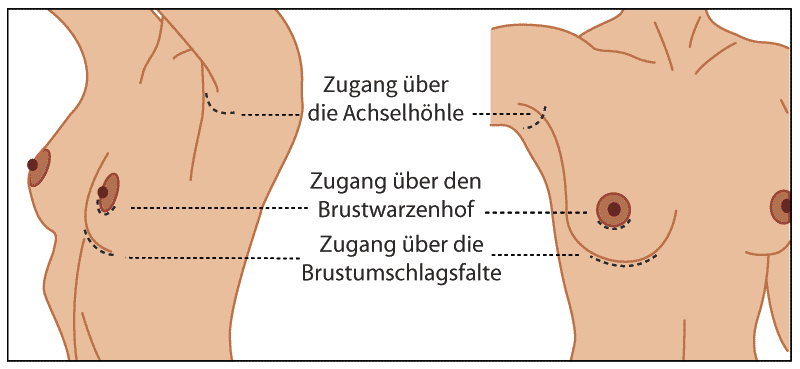 Brustvergrößerung in Düsseldorf, Dortmund, Stuttgart, Hamburg & Frankfurt -  Meine Schönheitschirurgie